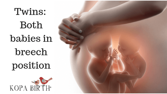 Natural Childbirth of Twins - Both Breech Position