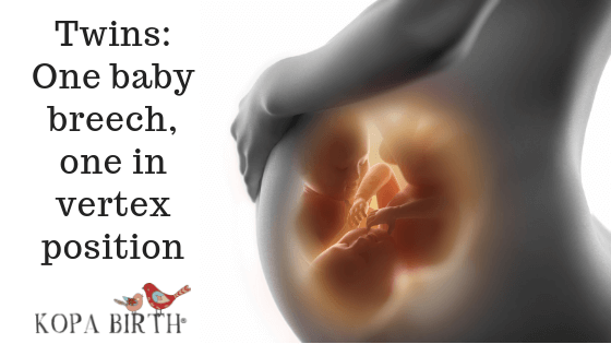Natural Childbirth of Twins- One Breech One Vertex Position