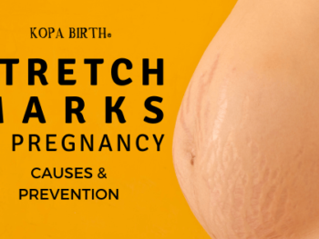 Stretch marks in pregnancy - causes & prevention - image