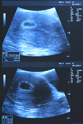 Week 6 Pregnancy Ultrasound