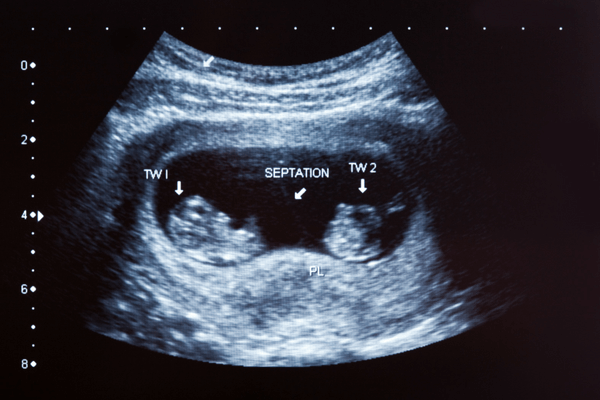 8 Weeks Pregnant Symptoms Belly Bump Twins Kopa Birth 