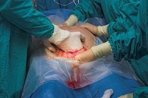assisted delivery vs c section - cesarean birth
