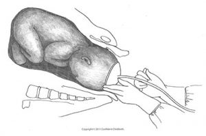 assisted delivery vs c section - vacuum assisted-delivery-vs-c-section-vacuum