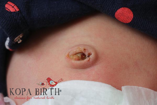 baby umbilical cord falling off - moist new belly button