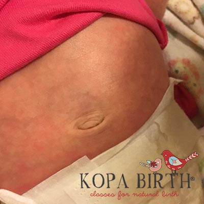 umbilical cord falling off - day 10